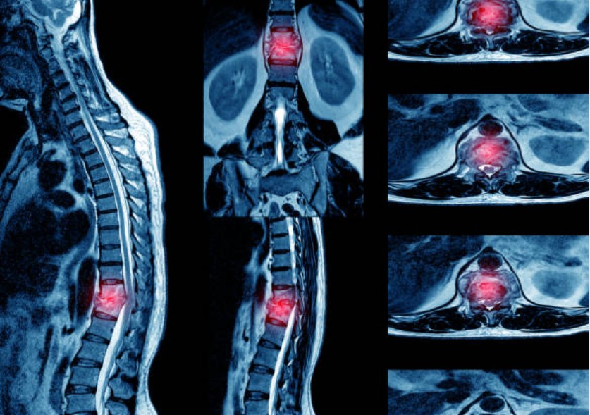How Is Spinal Stenosis Diagnosed and Evaluated
