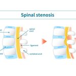 What Is the Newest Treatment for Spinal Stenosis Latest Updates