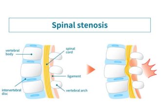 What Is the Newest Treatment for Spinal Stenosis Latest Updates