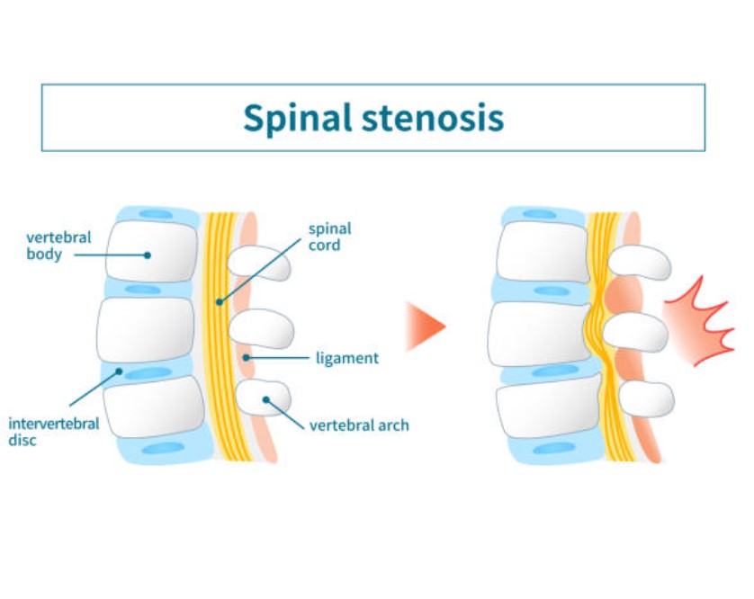 What Is the Newest Treatment for Spinal Stenosis Latest Updates