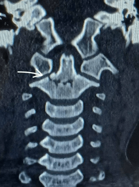 Lois's spinal cord remained intact