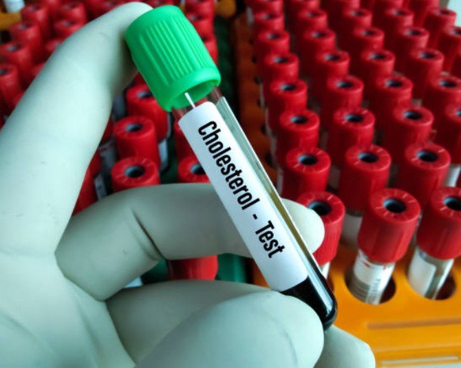 Cholesterol Blood Test