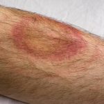 Lyme Disease