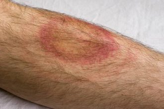 Lyme Disease