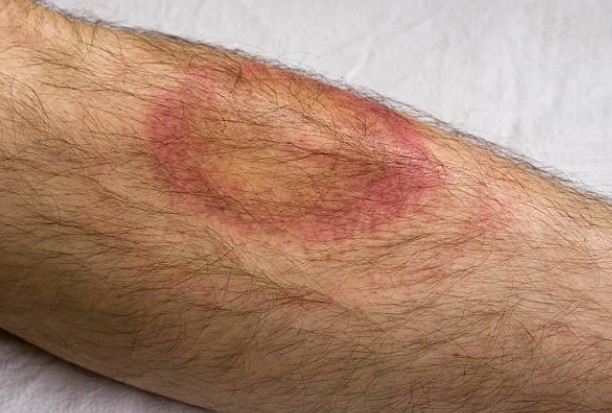 Lyme Disease