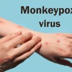 Monkeypox