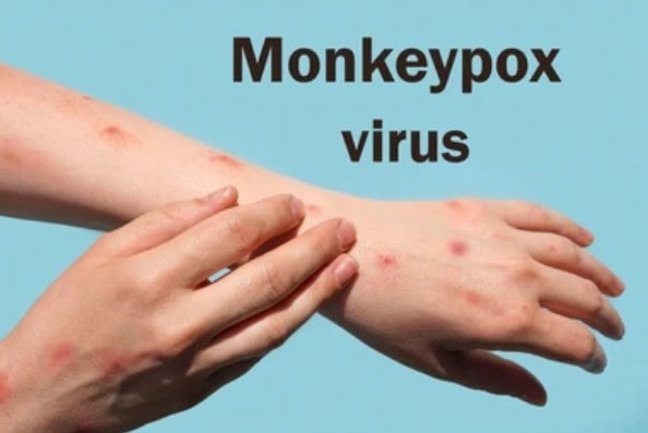 Monkeypox