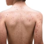 Chickenpox