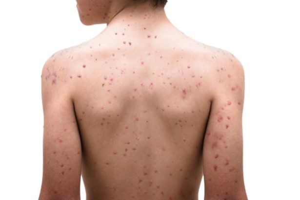 Chickenpox