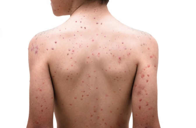 Chickenpox