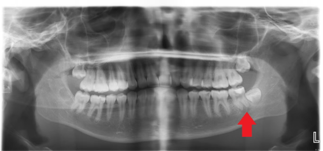Katelyn's decayed lower left second molar